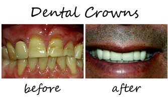 Dental Crowns 2