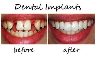 Dental Implants 3