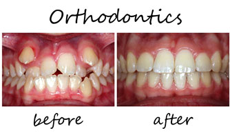 Orthodontics 4