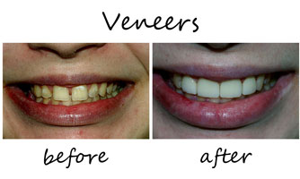 Veneers 1